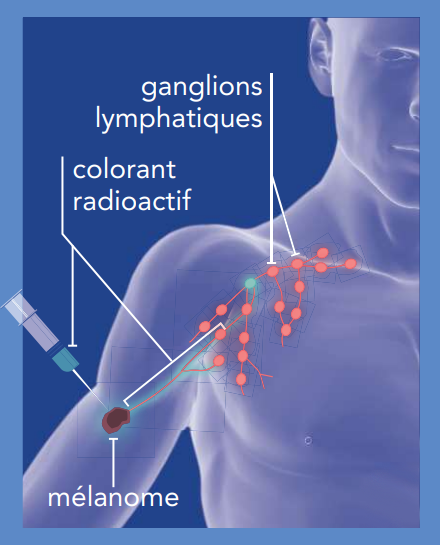 l’exérèse du ganglion sentinelle 