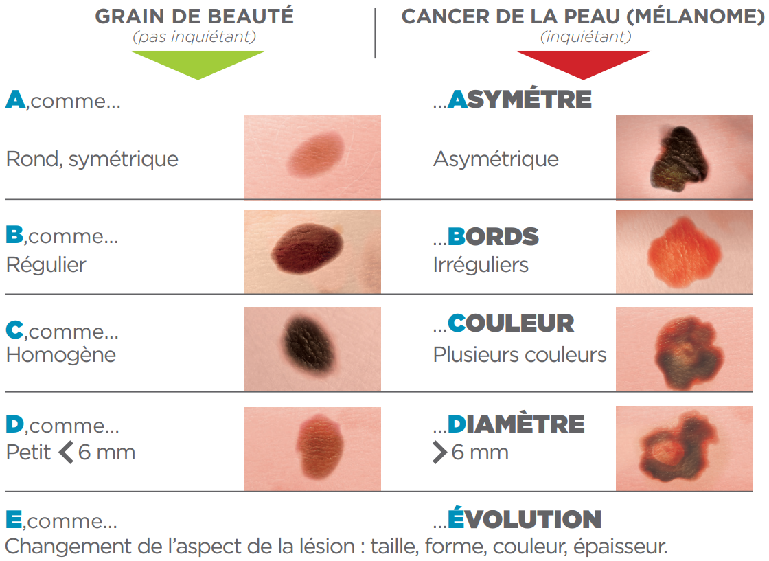 Prévention cancer de la peau. Regle ABCDE